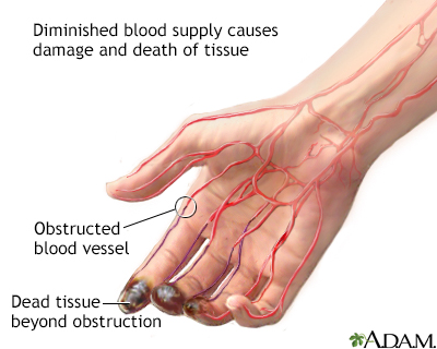 Thromboangiitis obliterans - Illustration Thumbnail
                      