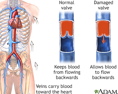 lower extremity venous reflux