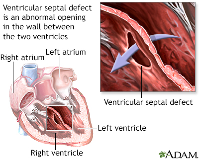 Endocardial cushion defect - SmartEngage