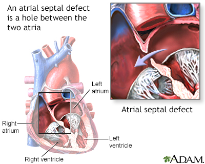 Atrial septal defect