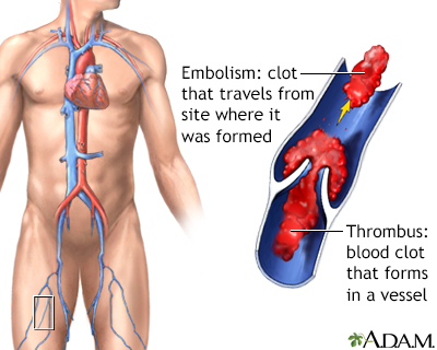 Thrombus - Illustration Thumbnail
                      