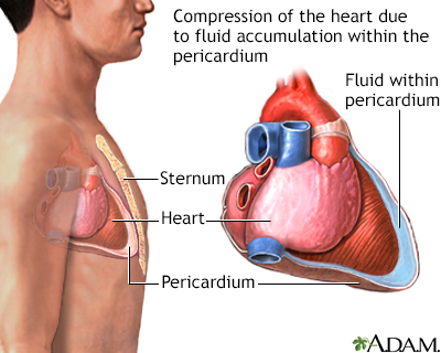 Cardiac tamponade - Illustration Thumbnail
                      