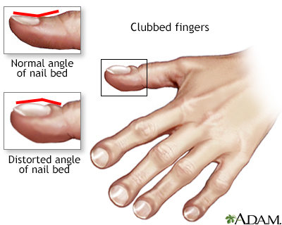 Clubbing Of The Fingers Or Toes Information Mount Sinai New York