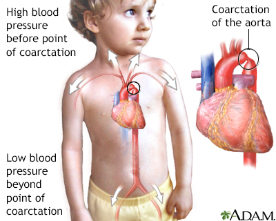 Coarctation de l'aorte