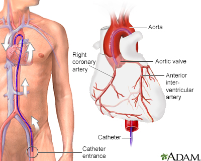 Angiographie coronarienne