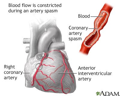 Coronary Artery Spasm - Symptoms and Causes