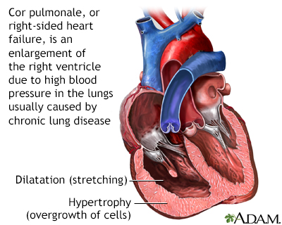 Cor pulmonale - Illustration Thumbnail
                      