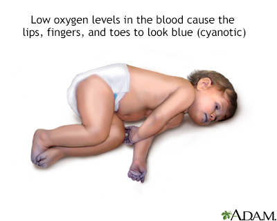 Cyanotic heart disease - Illustration Thumbnail
              