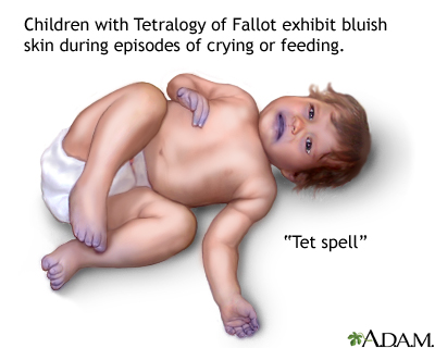 Tetralogy Of Fallot Information Mount Sinai New York