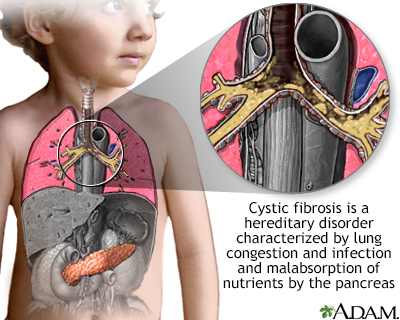 What is Cystic Fibrosis? Symptoms You Need to Know Now