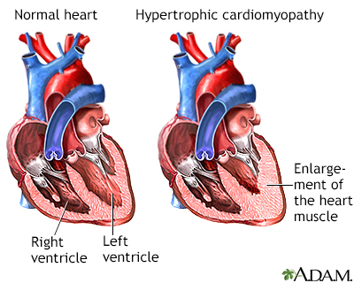 Hypertrophic Cardiomyopathy Information Mount Sinai New York