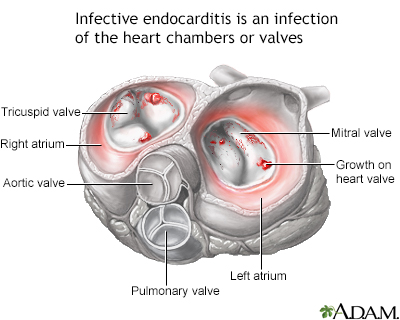Infective endocarditis - Illustration Thumbnail
              