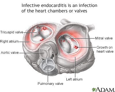 Infective endocarditis - Illustration Thumbnail
                      