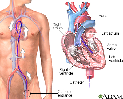 Left heart catheterization Information | Mount Sinai - New York