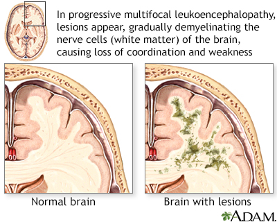 Leukoencephalopathy - Illustration Thumbnail
              