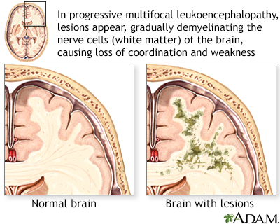 Leukoencephalopathy - Illustration Thumbnail
                      