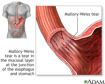 Mallory-Weiss tear - Illustration Thumbnail
                      