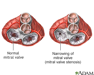 Mitral stenosis - Illustration Thumbnail              