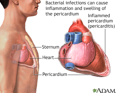 Bacterial pericarditis