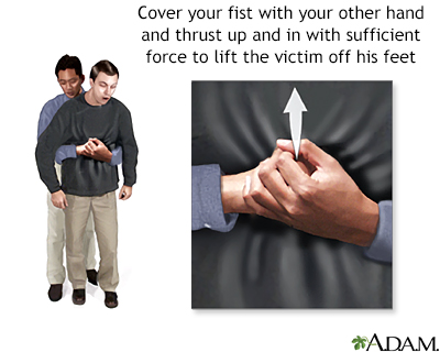 Heimlich maneuver on an adult