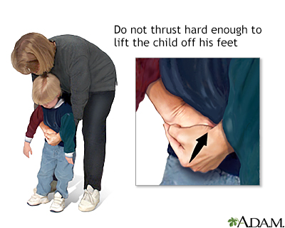 Heimlich maneuver on conscious child - Illustration Thumbnail
                      