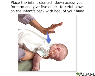 Heimlich maneuver on infant - Presentation Thumbnail              