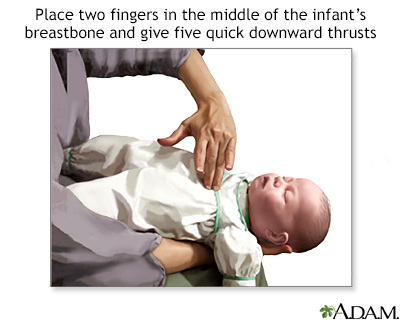 Heimlich maneuver on infant - Illustration Thumbnail
                      