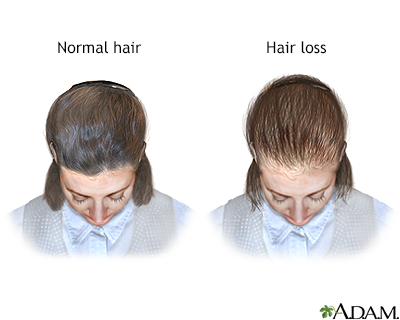 Female pattern baldness Information | Mount Sinai - New York
