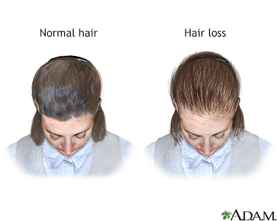 Female-pattern baldness - Illustration Thumbnail
              