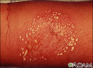 Pustules - superficial on the arm - Illustration Thumbnail
              