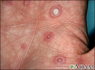 Erythema multiforme, target lesions on the palm - Illustration Thumbnail              