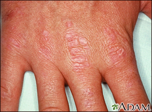 Dermatomyositis - Gottron's papules on the hand - Illustration Thumbnail
                      