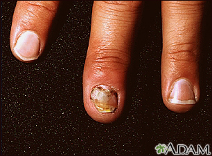 How to care for a nail that is falling off Nail Abnormalities Information Mount Sinai New York