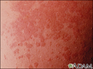 Tinea corporis Information