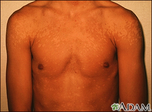 Tinea versicolor Information