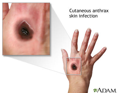 Anthrax Disease Inhalation