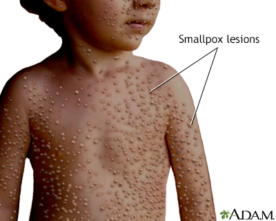 Smallpox lesions