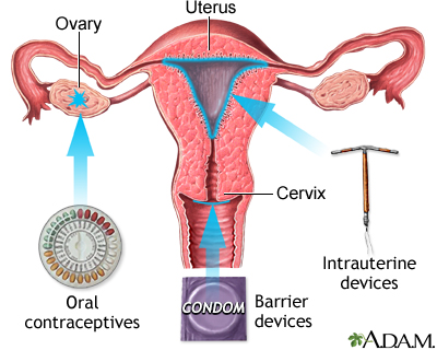 Birth control methods - Illustration Thumbnail
                      