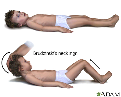 Brudzinski's sign of meningitis