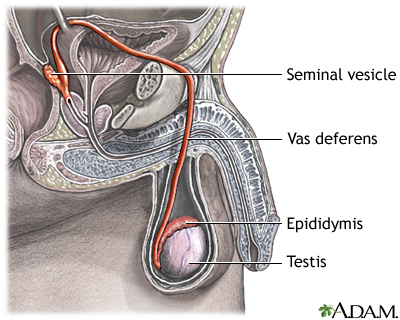 Epididymitis Information Mount Sinai New York