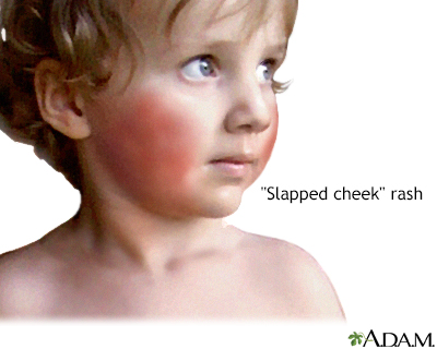 Fifth disease - Illustration Thumbnail              