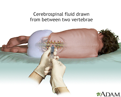 Lumbar puncture (spinal tap) - Illustration Thumbnail							