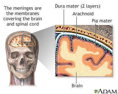 Meningitis Pneumococcal Information Mount Sinai New York