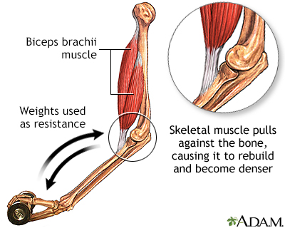 Osteoporosis - Symptoms and Causes