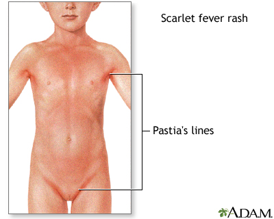 Scarlet fever Information