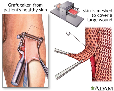 Sæbe vinder Nedrustning Skin graft Information | Mount Sinai - New York