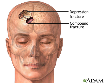 Skull fracture - Illustration Thumbnail
              