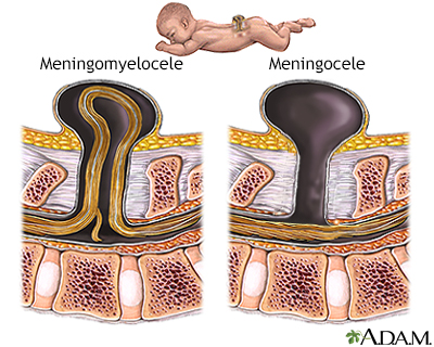 Spina bifida (degrees of severity) - Illustration Thumbnail
              