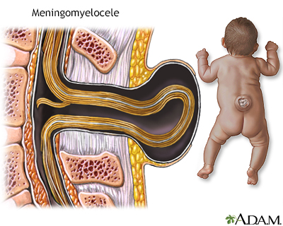 Spina bifida - Illustration Thumbnail
                      