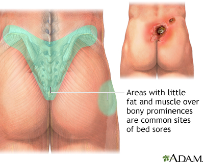 Areas where bedsores occur - Illustration Thumbnail
                      